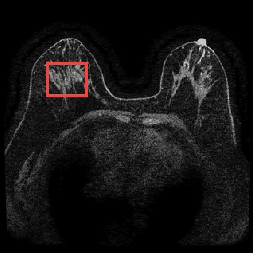 Illustration for Exploring patient data requirements in training effective ai models for mri-based breast cancer classification